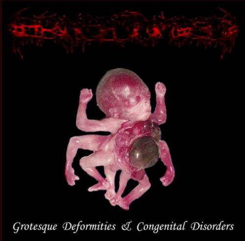 Laryngectomized : Grotesque Deformities a Congenital Disorders